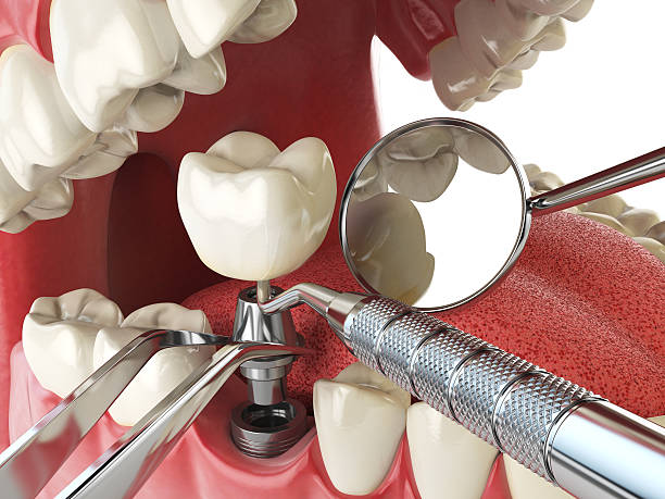 Best Emergency Root Canal Treatment in Country Homes, WA
